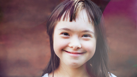 Nahaufnahme eines jungen lachenden M&auml;dchens mit geistiger Behinderung 